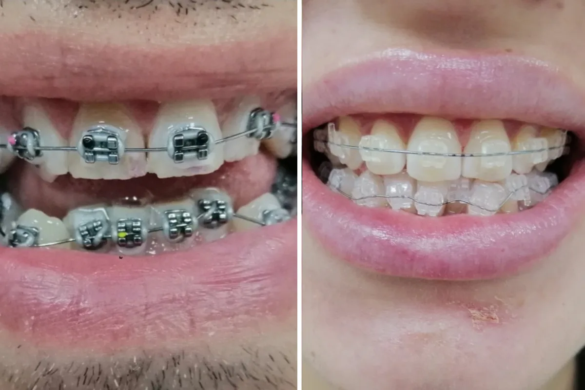 Teeth with metal fixed braces on the left, teeth with clear sapphire braces on the right