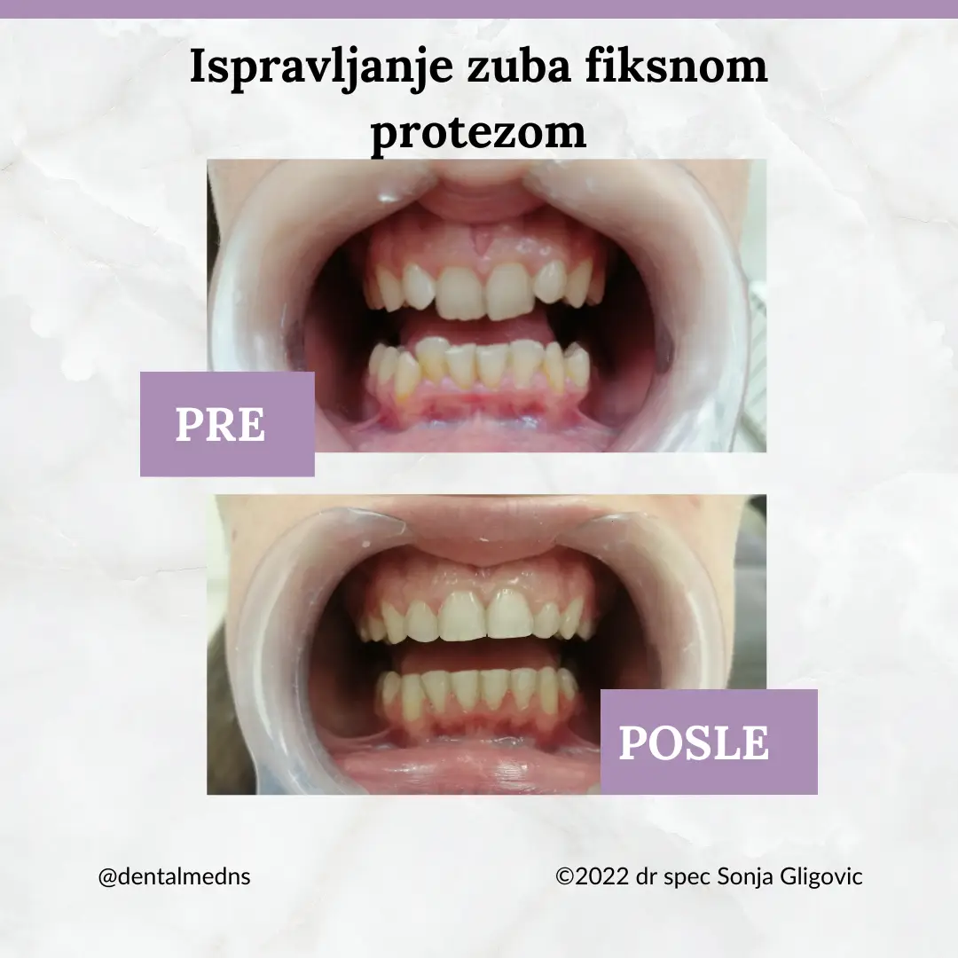 Pre i posle: ispravljanje krivih prednjih zuba fiksnom protezom, terapija 18 meseci
