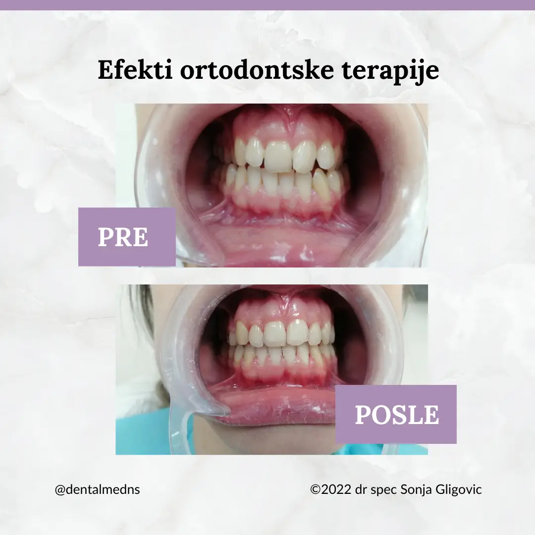 Pre i posle: korekcija zagrižaja i razmaka između zuba fiksnom protezom, 14 meseci