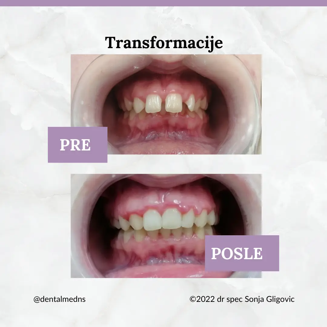 Pre i posle: kompletna estetska transformacija osmeha fiksnom protezom, 22 meseca