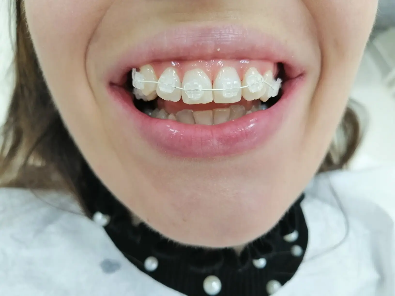 safirni-estetski fiksni aparat